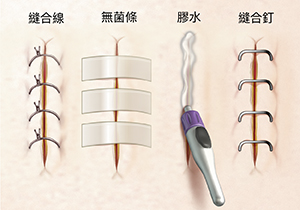 切口特寫，顯示縫合線、無菌條、膠水和縫合釘。