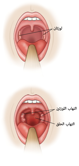 منظر مقرب للحلق يبين اللوزتين في حالة طبيعية ومنظر آخر يبين اللوزتين والحلق في حالة التهاب.