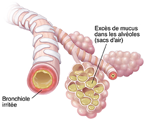 Bronchiole et sac alvéolaire montrant une accumulation de sécrétions et de l'inflammation causés par une pneumonie.