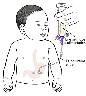 Silhouette d'un bébé avec une sonde insérée dans l'estomac. Le port d'alimentation est près de la peau, et la pince est ouverte sur la sonde de rallonge. La seringue d'alimentation est insérée dans la sonde de rallonge. Les aliments liquides s'écoulent dans l'estomac du bébé.
