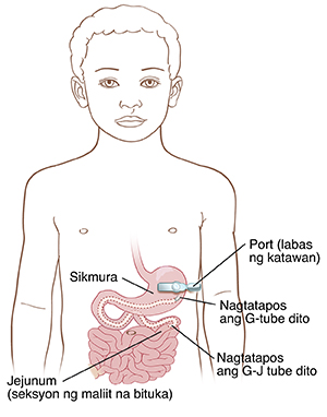 Front view ng batang lalaki na ipinakikita ang sikmura at maliit na bituka. Nasa labas ng katawan ang port sa ibabaw ng sikmura. Nakakonekta ang tubo sa port at pumapasok sa balat. Nagtatapos ang G-tube sa sikmura. Nagtatapos ang G-J tube sa jejunum (seksyon ng maliit na bituka).