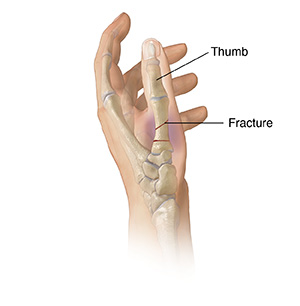 Side view of hand showing bones with thumb fracture