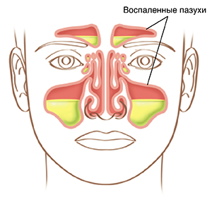 Изображение лица с воспаленными пазухами носа.