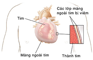 Phác họa ngực người cho thấy tim và màng ngoài tim. Mặt cắt ngang cận cảnh cho thấy hai lớp màng ngoài tim bị viêm với chất lỏng ở giữa hai lớp trên cùng của thành tim.